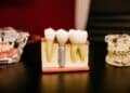 How Age Affects Dental Implant Eligibility
