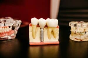 How Age Affects Dental Implant Eligibility